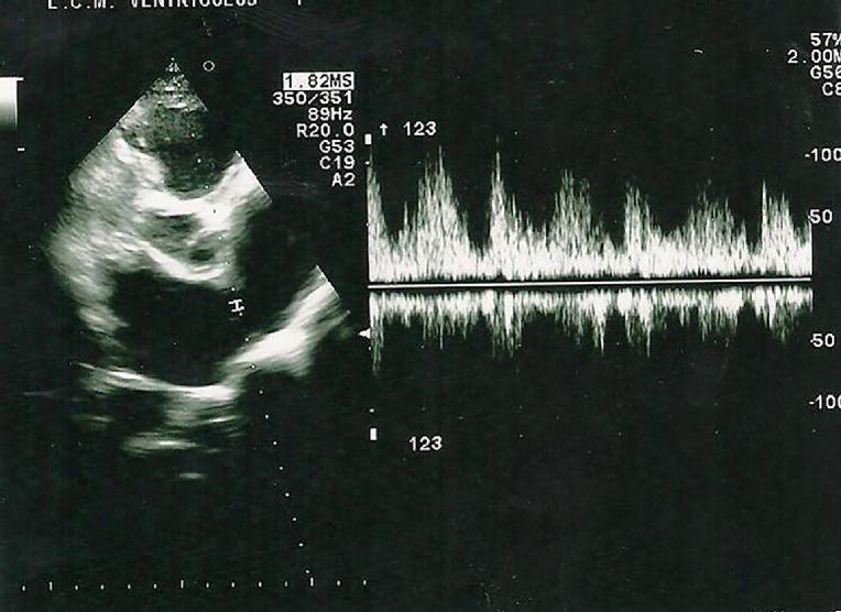 Heart failure in athletes pathophysiology and diagnostic management
